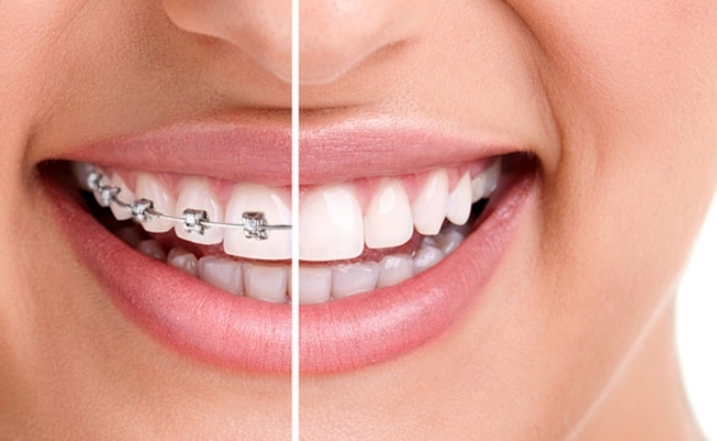 Braces