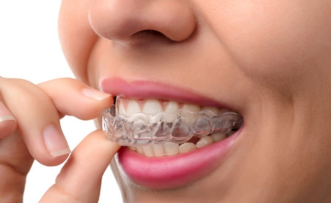 Clear aligners (e.g., Invisalign)------32