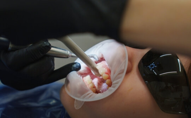 Fluoride treatment