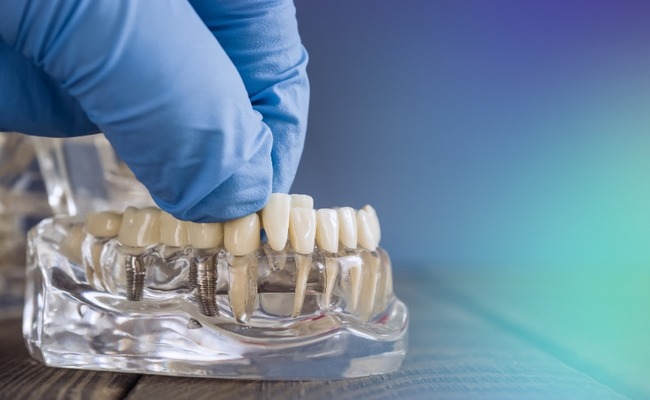 Implants (under Prosthodontics) (1)