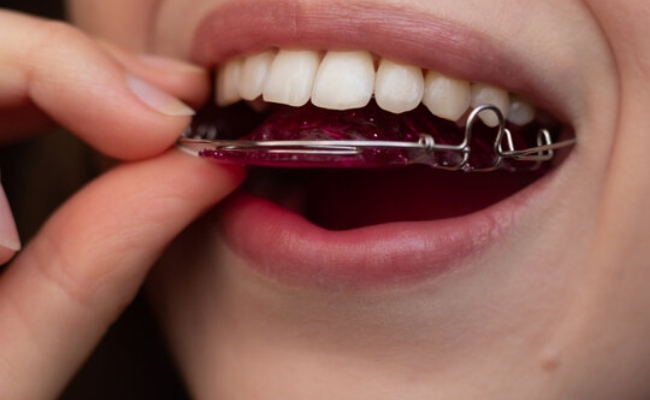 Retainers-