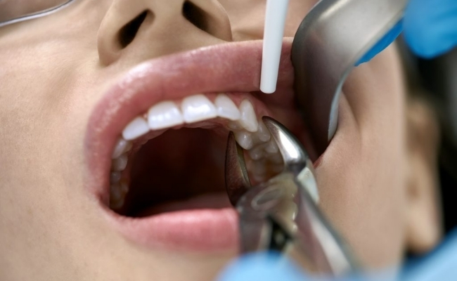 Tooth extractions (including wisdom teeth)------32