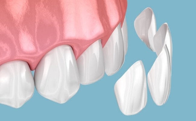 Veneers